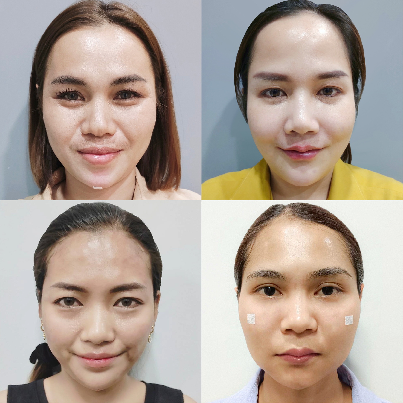 รวมรีวิวเติมฟิลเลอร์คาง